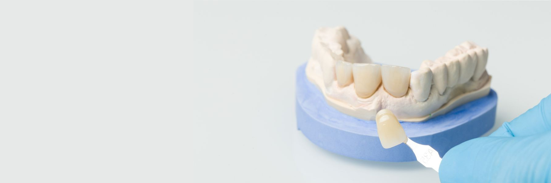 Veneers | Dentist
