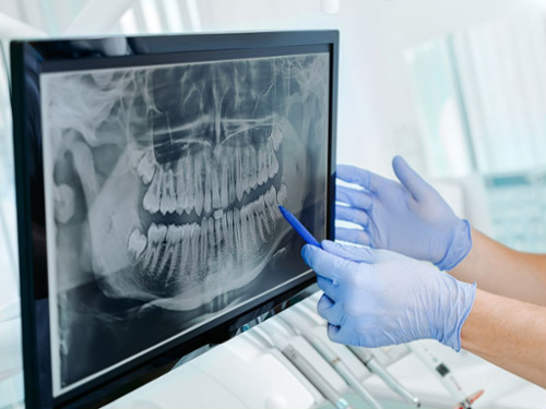 Panoramic X-Rays